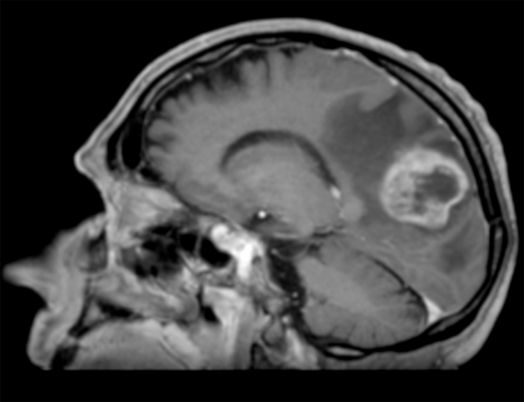 Image IRM d'un glioblastome