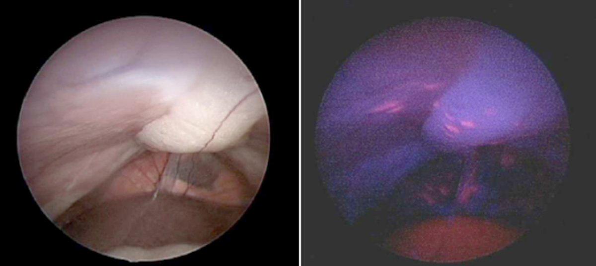 Peritoneal carcinomatosis