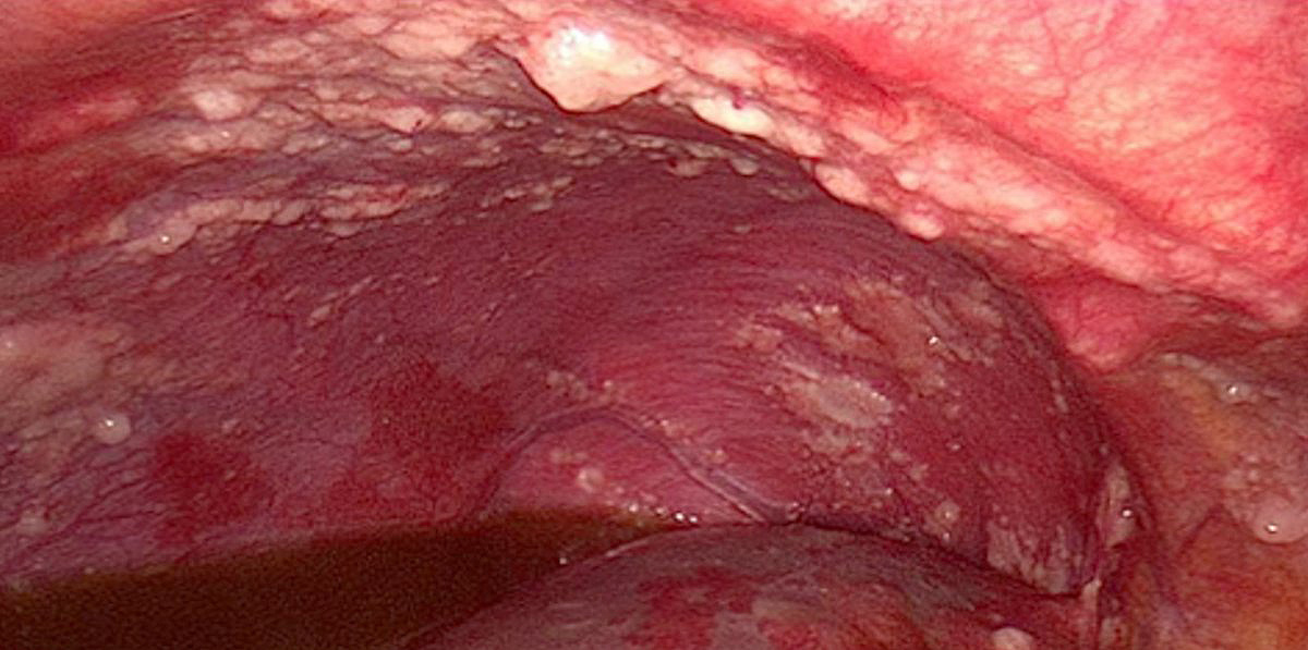 Peritoneal carcinomatosis