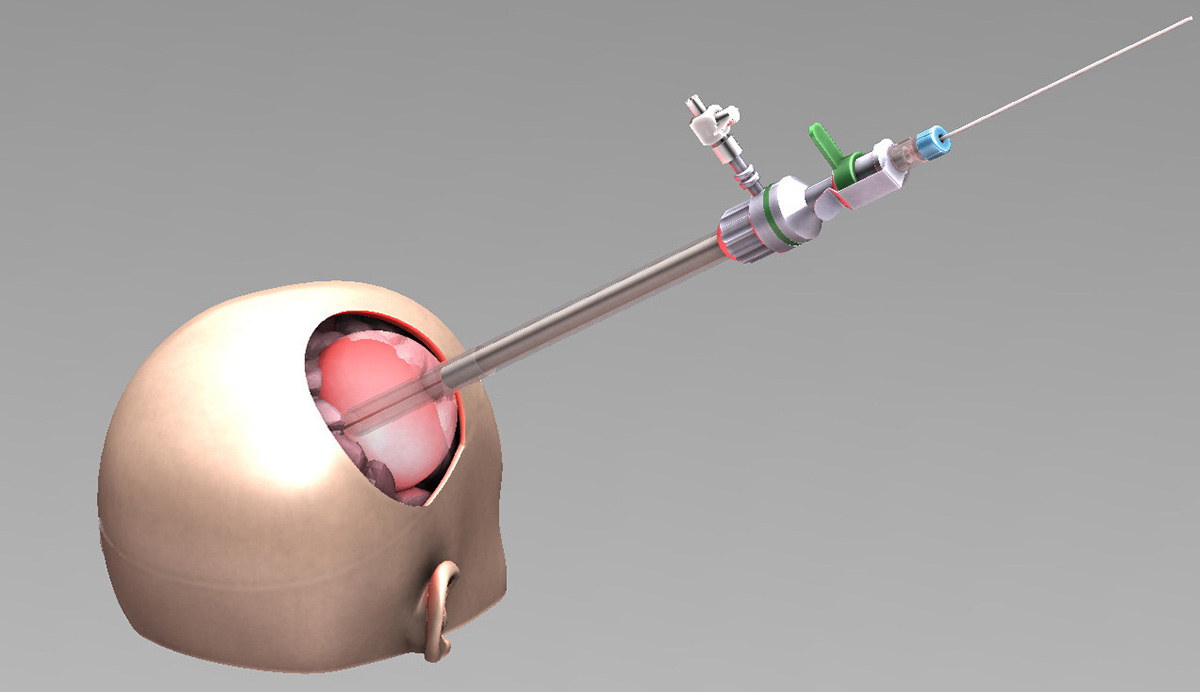 Medical device to deliver PDT