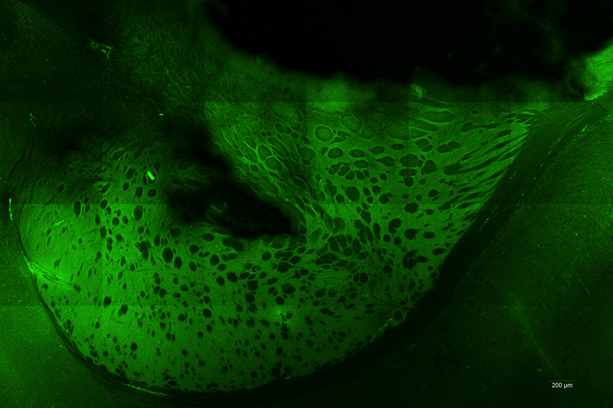 Glioblastome au microscope