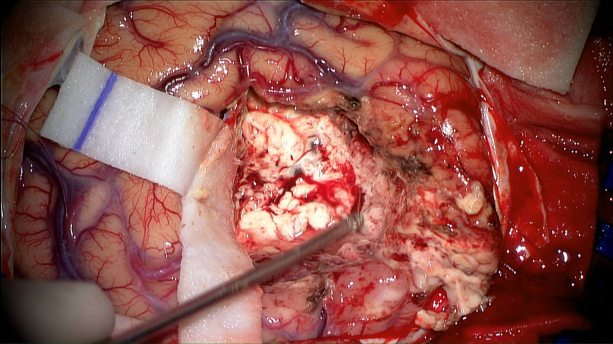 Surgery for the treatment of Glioblastoma microscopy view with white light