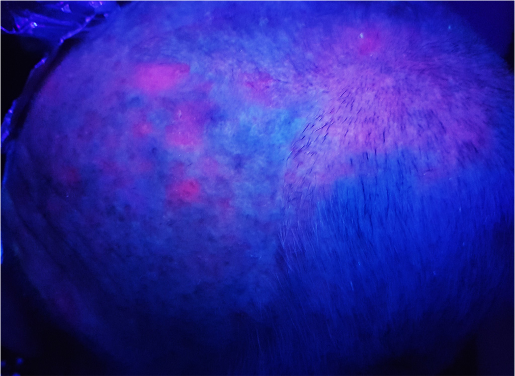 Actinic keratoses highlited with blue light