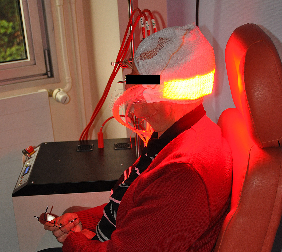 Photodynamic treatment of actinic keratoses of the scalp