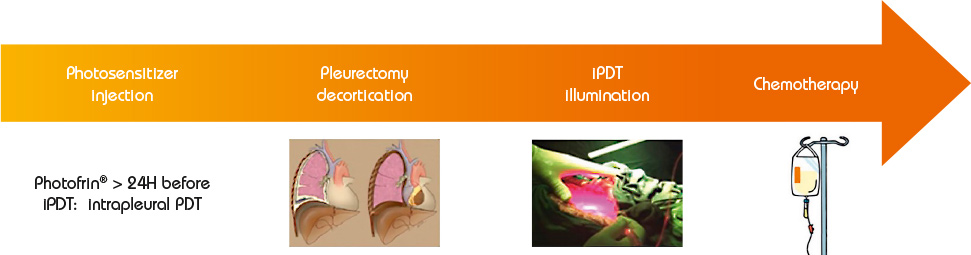 Roadmap of photodynamic therapy for malignant  pleural mesothelioma