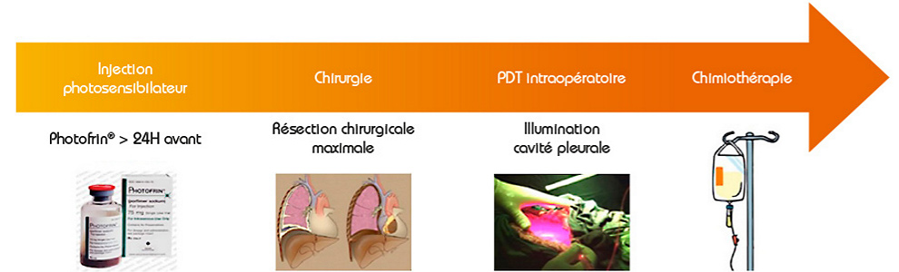 Traitement du mésothélium pleural malin, objectifs