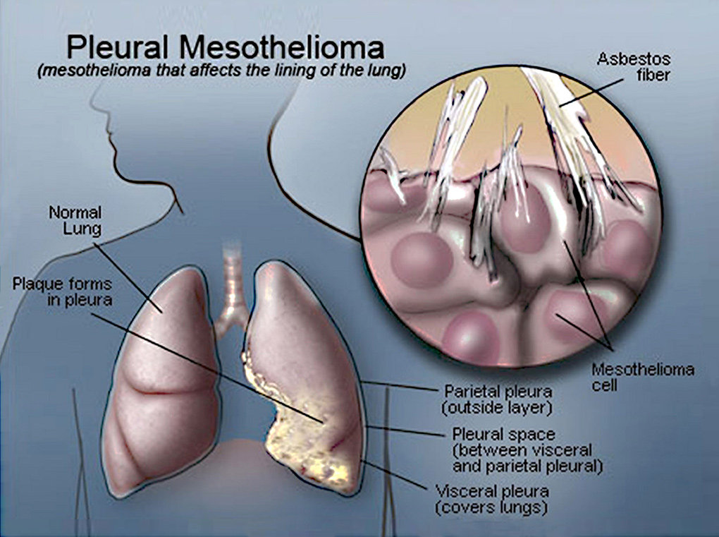 Schéma mésothélium pleural malin