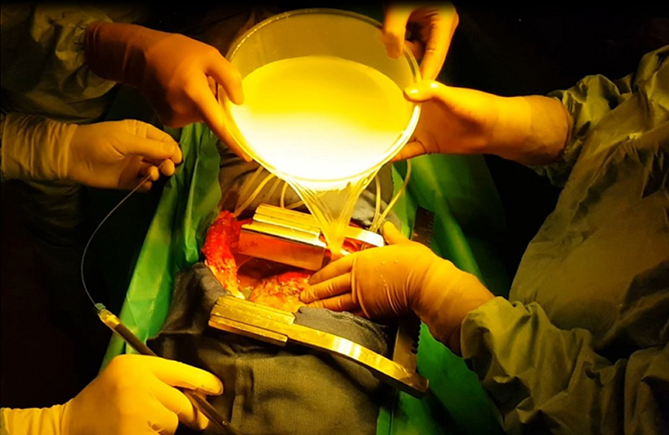 Photodynamic treatment of mesothelial pleural operative room
